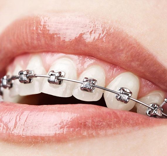 ortodonciarivero ORTODONCIA BAJA FRICCION