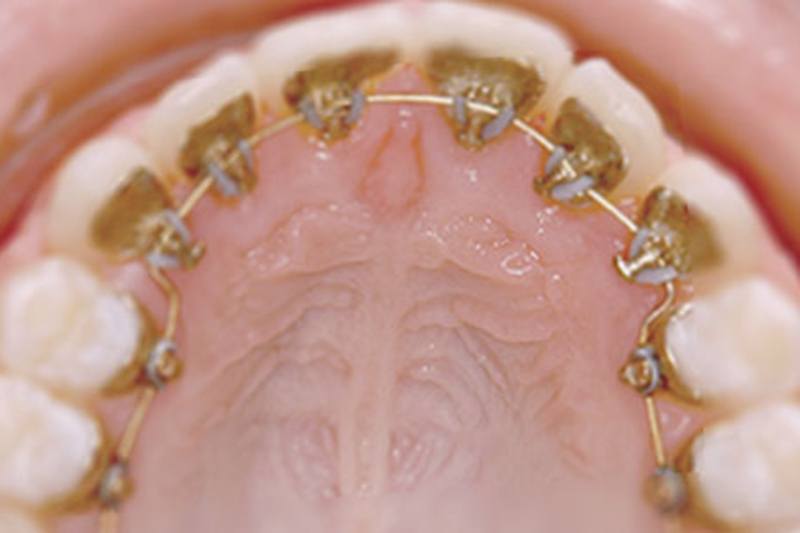ortodonciarivero ORTODONCIA LINGUAL