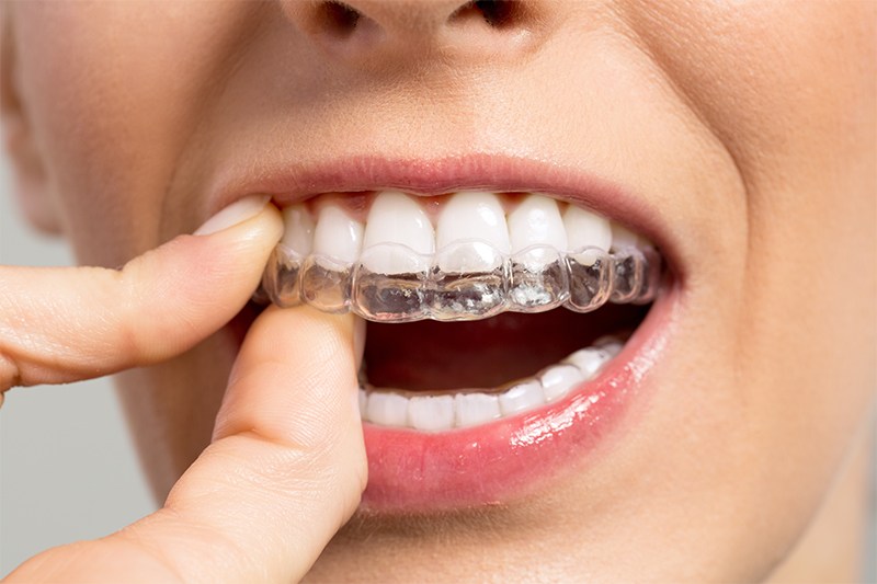 ortodonciarivero servicios invisalign