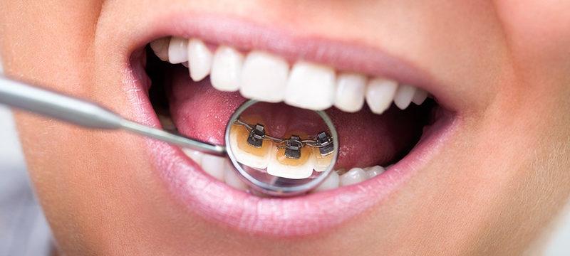 ortodonciarivero servicios lingual