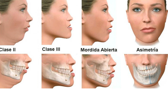 Ortodoncia con cirugia ortognatica