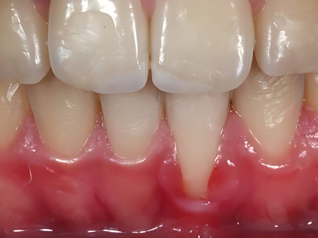 Ortodoncia en encias retraidas