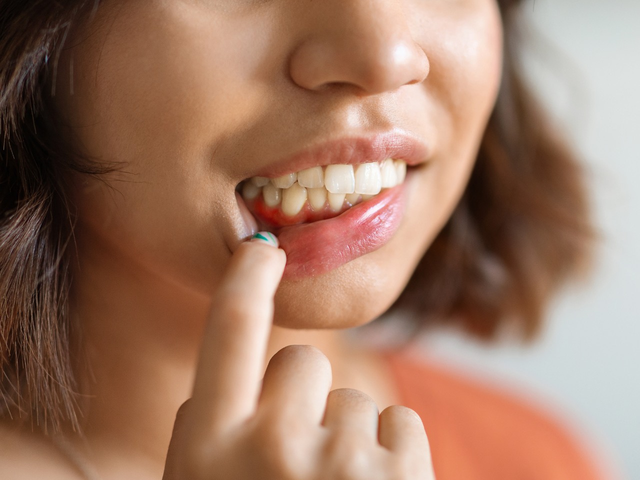 Recesión gingival y ortodoncia