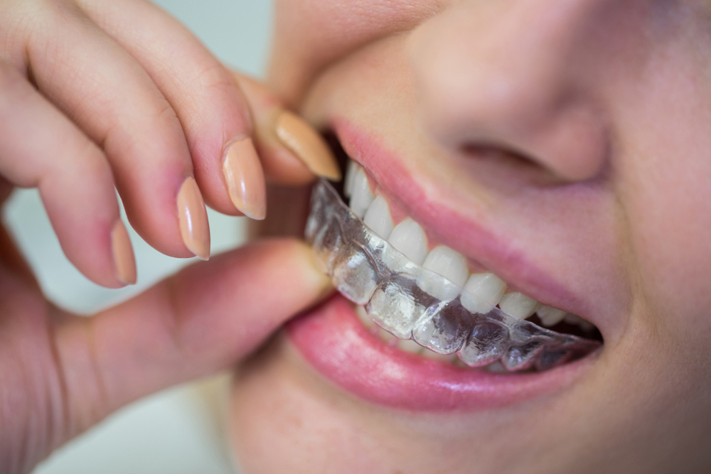 he perdido alineadores invisalign