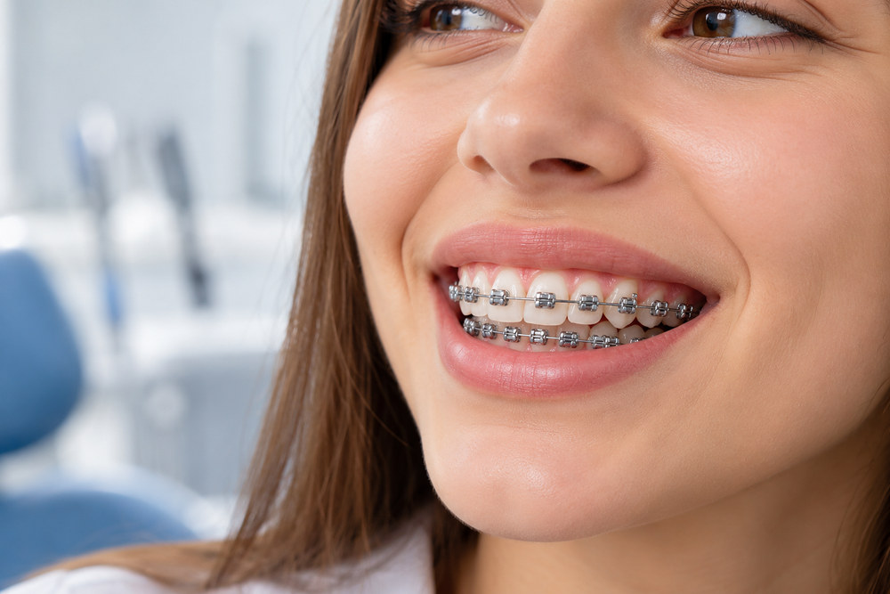 brackets autoligables que son