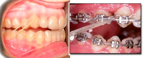 Elásticos en ortodoncia? Ortodoncia Rivero